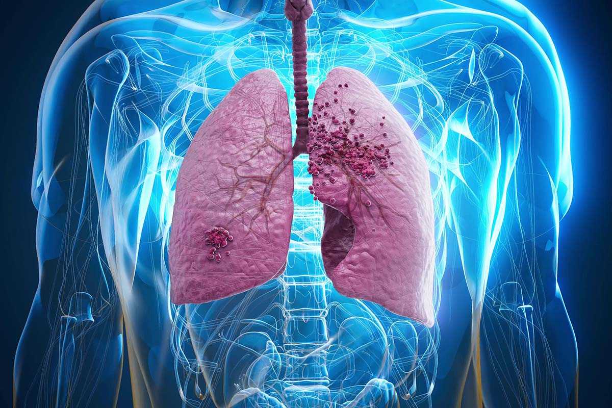 Phase III IPF Clinical Trial Delivered Across Asia-Pacific 